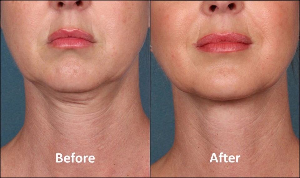 13 Facts How Kybella Can Help Get Rid Of Your Double Chin Without Going ...