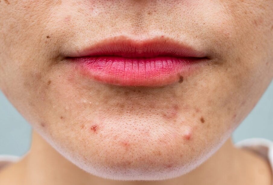 EVERYTHING YOU NEED TO KNOW ABOUT ACNE TREATMENT