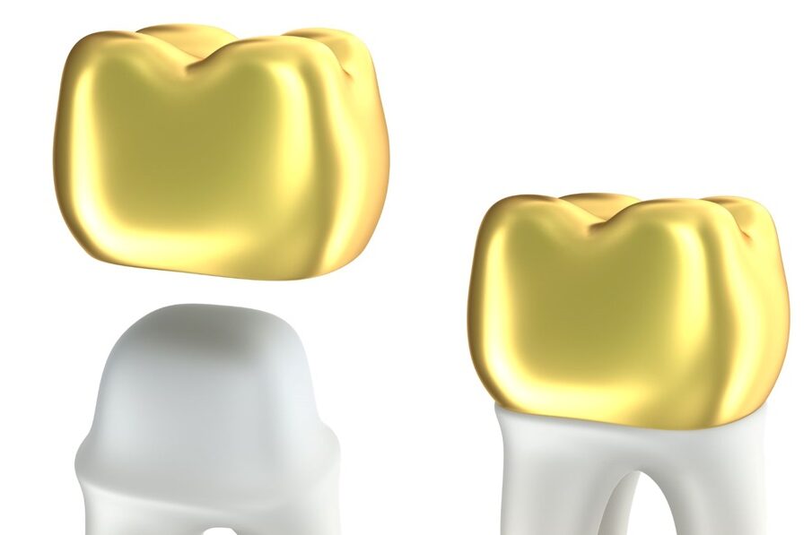 Dental Crown Procedure