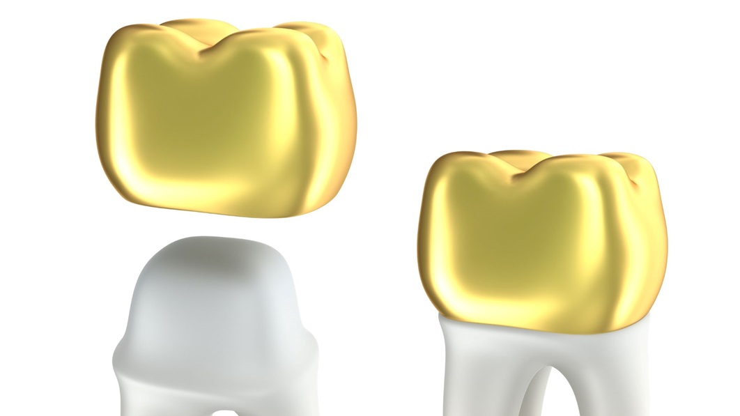 What is the Recovery Period After a Dental Crown Procedure?
