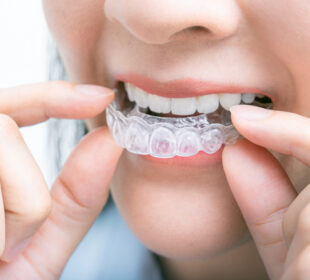 Invisalign