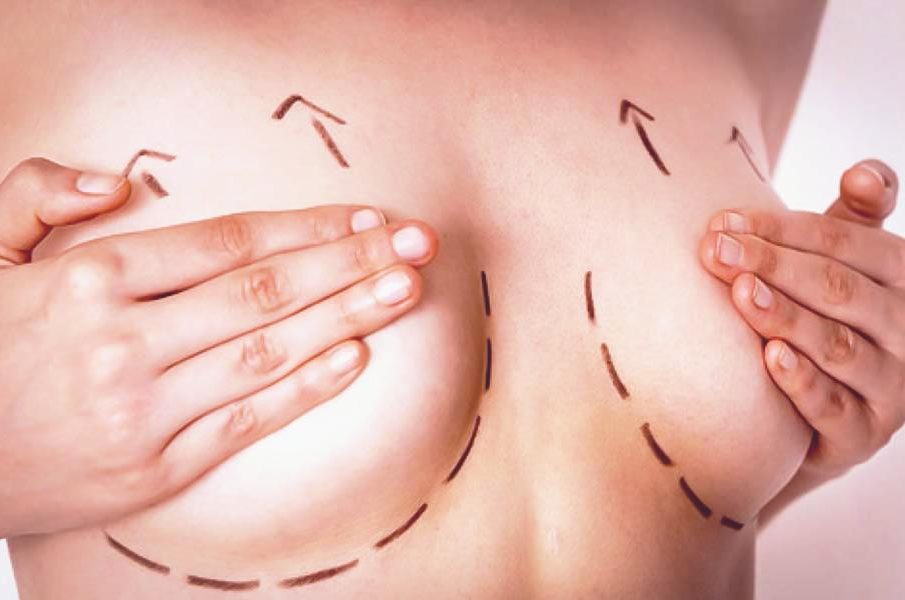 Breast Lift Surgery